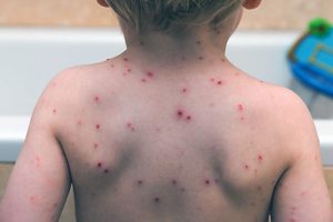 MMRV Vaccine